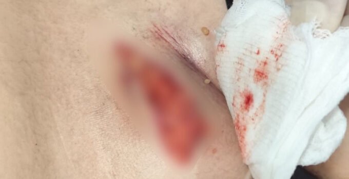 Taburcu edilmek istenen çocuğun idrar kesesinin patladığı ortaya çıktı