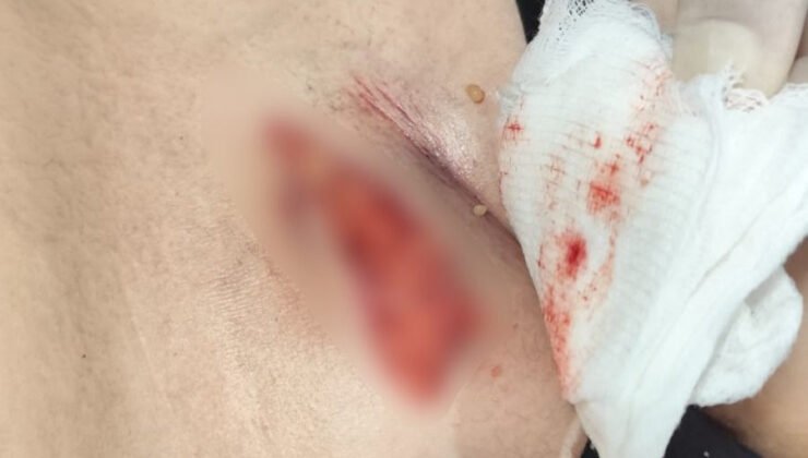 Taburcu edilmek istenen çocuğun idrar kesesinin patladığı ortaya çıktı