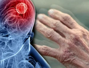 Tarım Ilaçları Parkinson Riskini Artırabilir